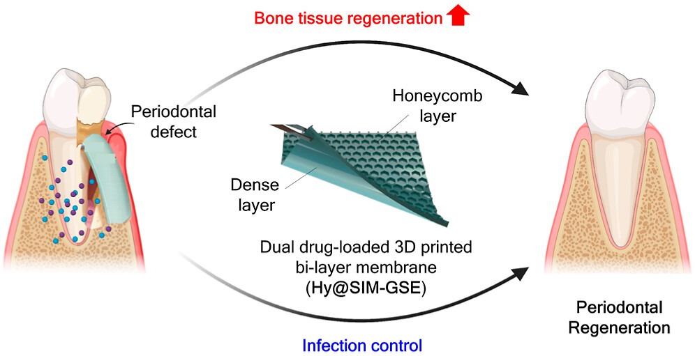 3D프린팅으로 제작된 차별적 이중층 막은 벌집 모양과 밀집된 층으로 구성된 치주조직의 계층적 구조를 모방한다. 제안된 구조물은 이중 약물 전달 시스템으로서, 뼈 조직 재생을 촉진하는 약물인 심바스타틴(SIM)과 항균 특성을 가진 경제적인 천연 화합물인 포도씨 추출물(GSE)을 방출한다